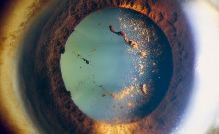 Photographie d'un œil atteint d'une uvéite