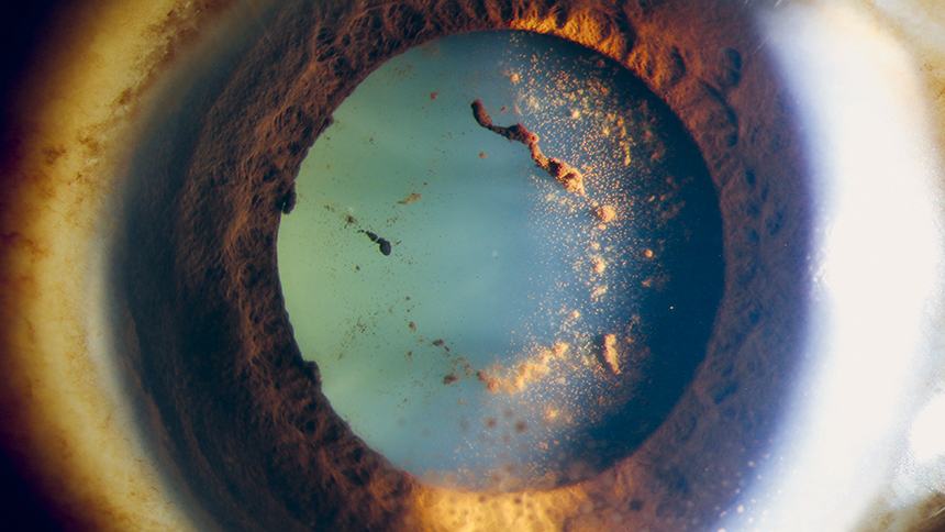 Photographie d'un œil atteint d'une uvéite