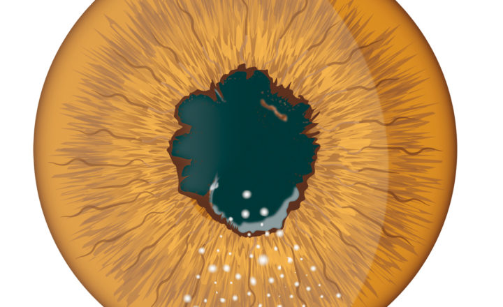 Illustration uvéite
