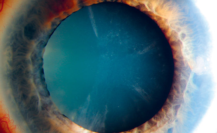 Photo d'une cataracte