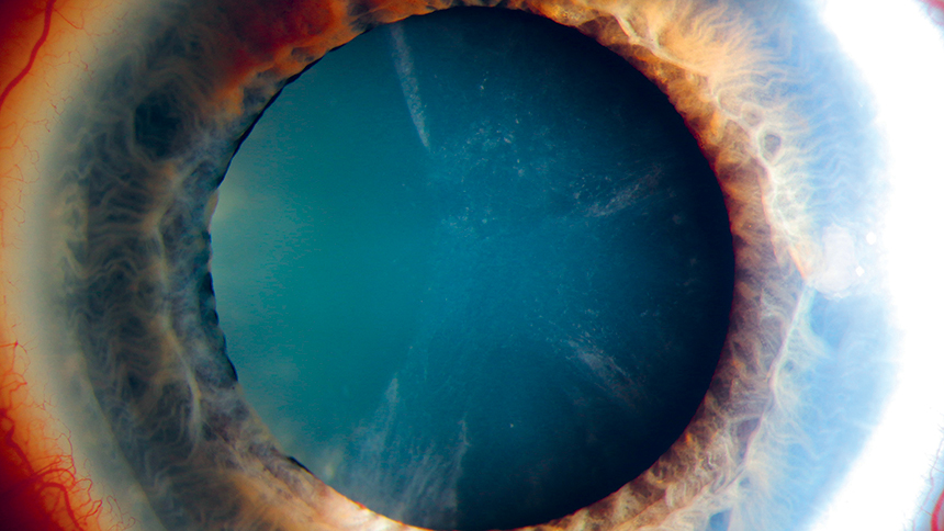 Photo d'une cataracte