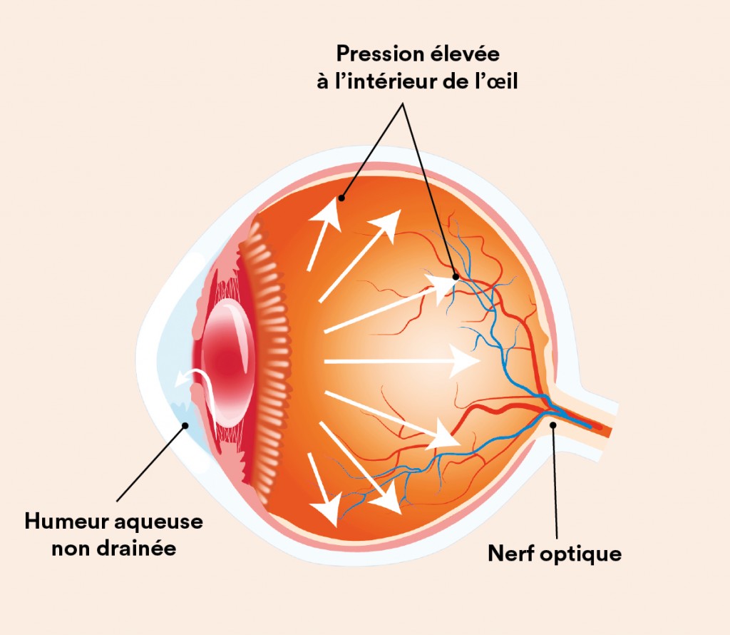 Schéma d'un œil atteint par la maladie du glaucome
