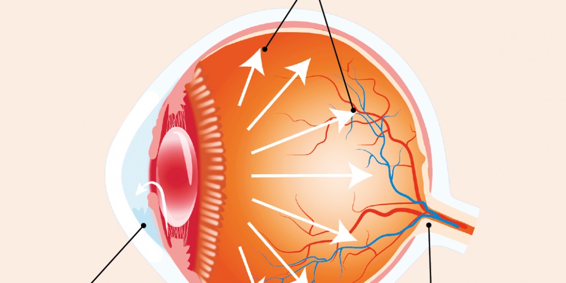 Schéma d'un œil atteint du glaucome