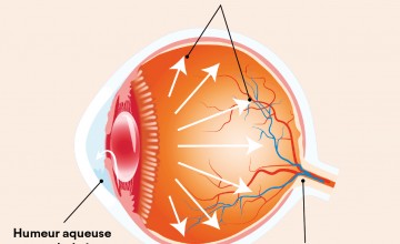Schéma d'un œil atteint du glaucome