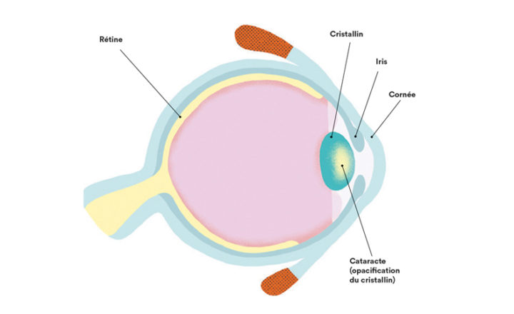 cataracte