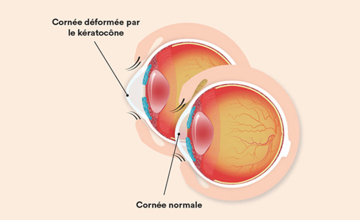 Illustration du kératocône