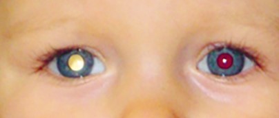 Photo des yeux d'un enfant réfléchissant la lumière d'un flash. L'un des yeux est rouge et l'autre est blanc.
