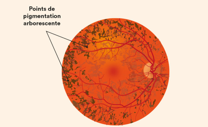 Schéma explicatif de la rétinite pigmentaire