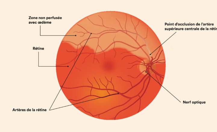 illustration AVC de l'oeil