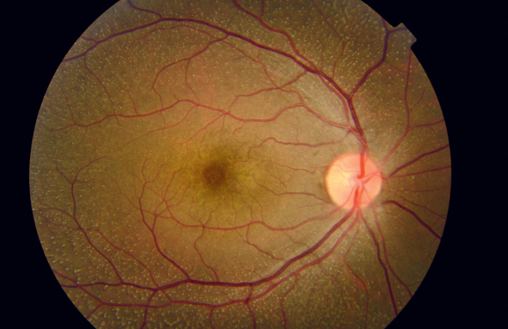 Fond d'oeil pour article innovations ophtalmologie