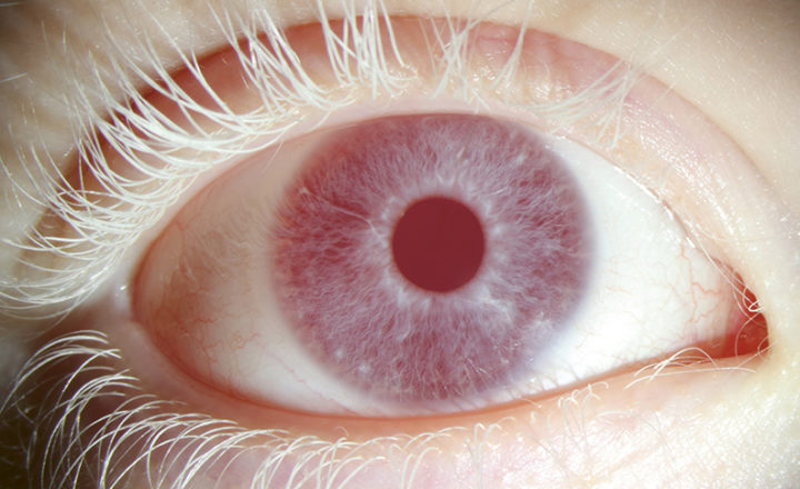 Photo d'un oeil atteint d'albinisme oculaire