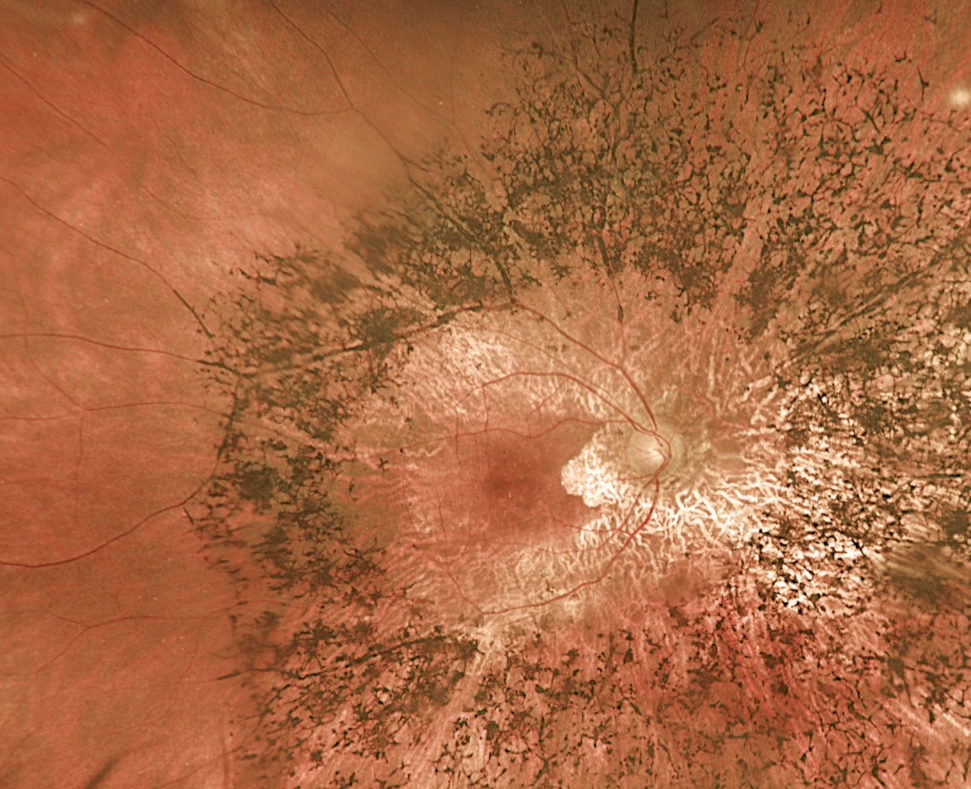 Image du fond d'oeil d'un patient avec une rétinite pigmentaire
