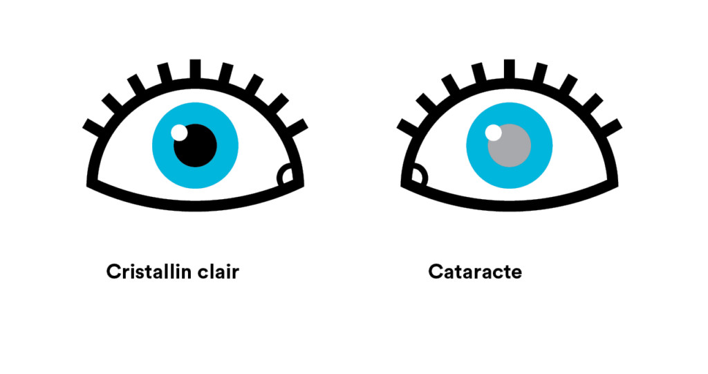 Illustration d'un oeil avec un cristallin clair et d'un autre avec une cataracte