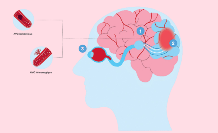 Schéma d'un AVC dans le cerveau