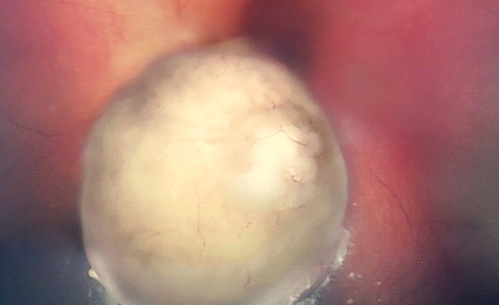 Image d'un rétinoblastome