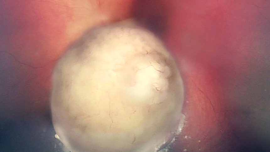 Image d'un rétinoblastome