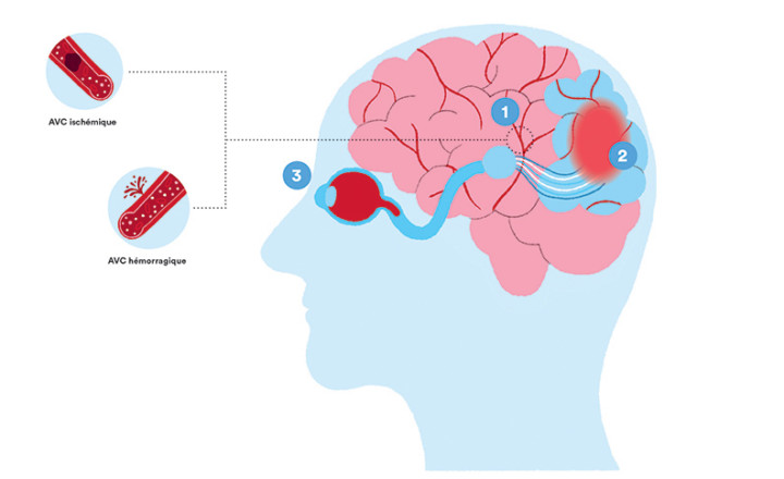 Schéma d'un AVC dans le cerveau