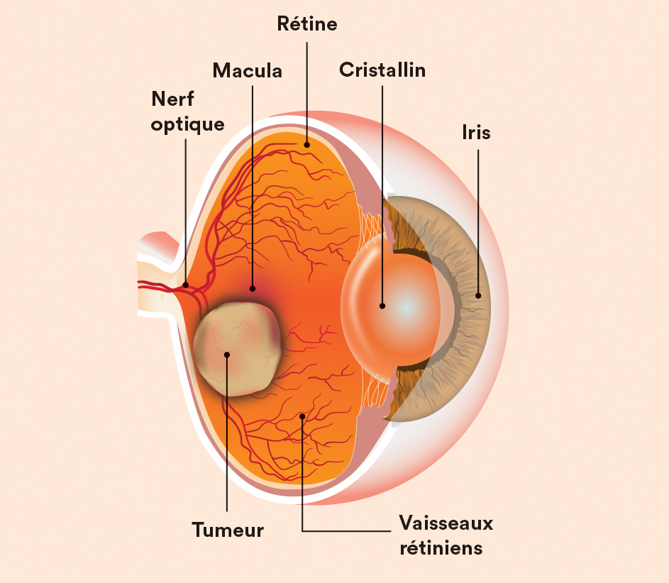 Schéma de l'oeil représentant le rétinoblastome