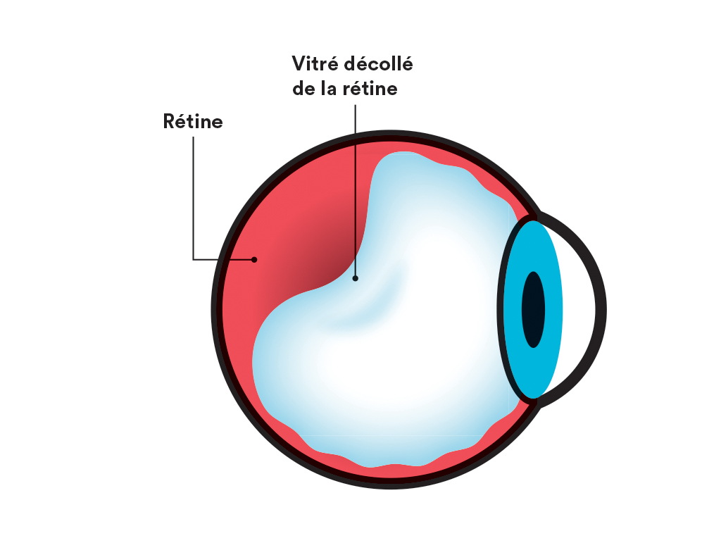 Schéma de l'oeil représentant le vitré qui se décolle de la rétine.