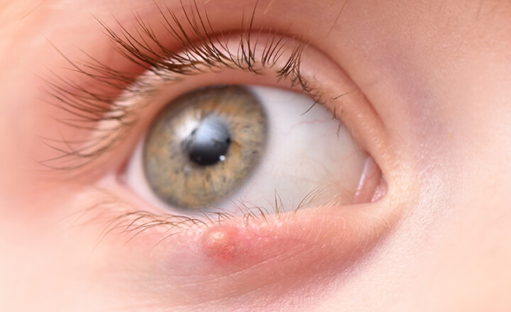 Jeune patient présentant un chalazion au niveau de sa paupière inférieure.