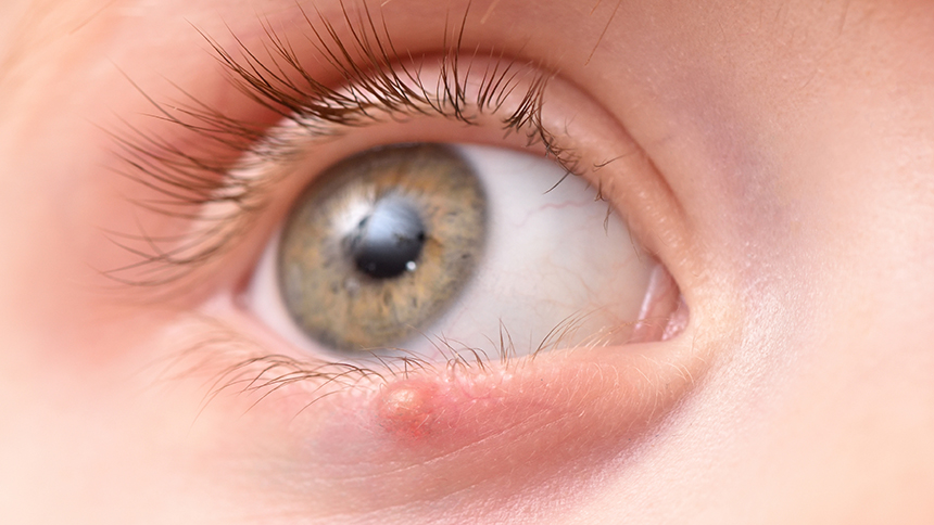 Jeune patient présentant un chalazion au niveau de sa paupière inférieure.