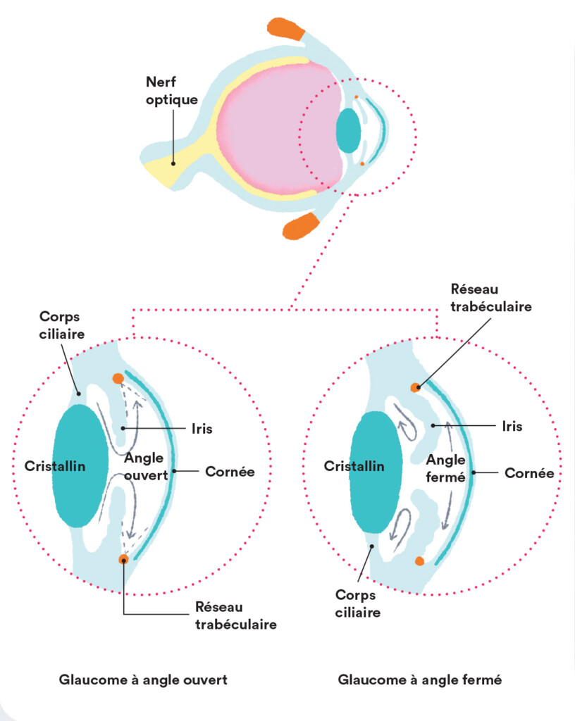 Schéma de l'œil montrant un glaucome. 