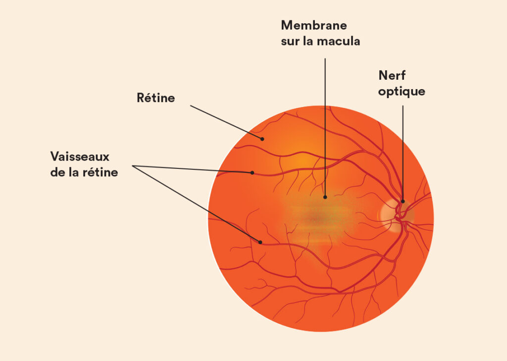 Schéma expliquant la membrane épirétinienne