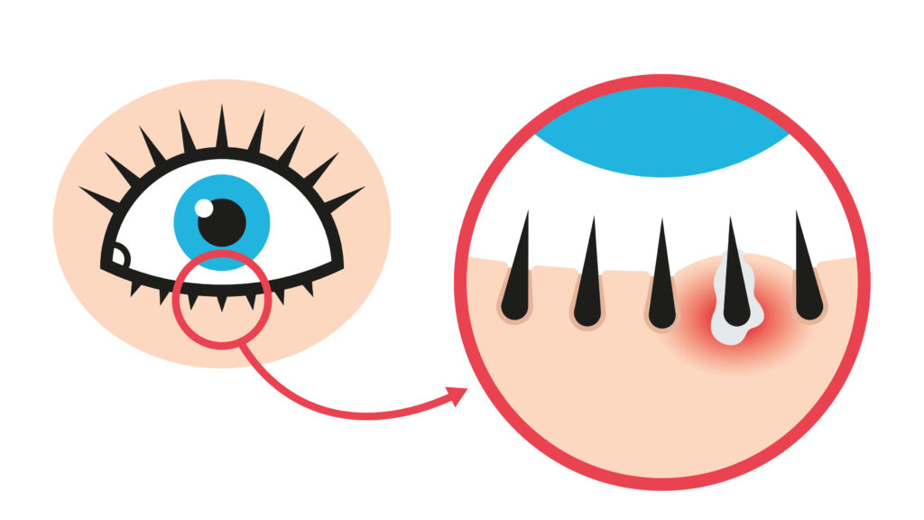 Illustration d'une inflammation des glandes et d'un orgelet. 